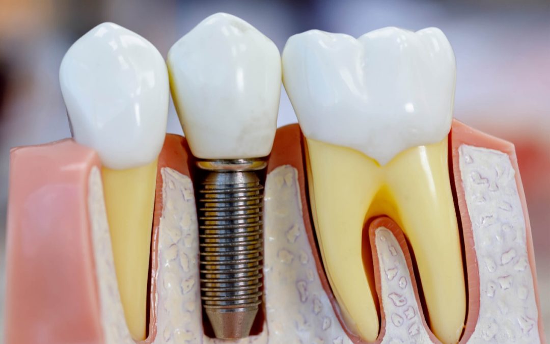 Indicações e contra indicações do Implante Dentário